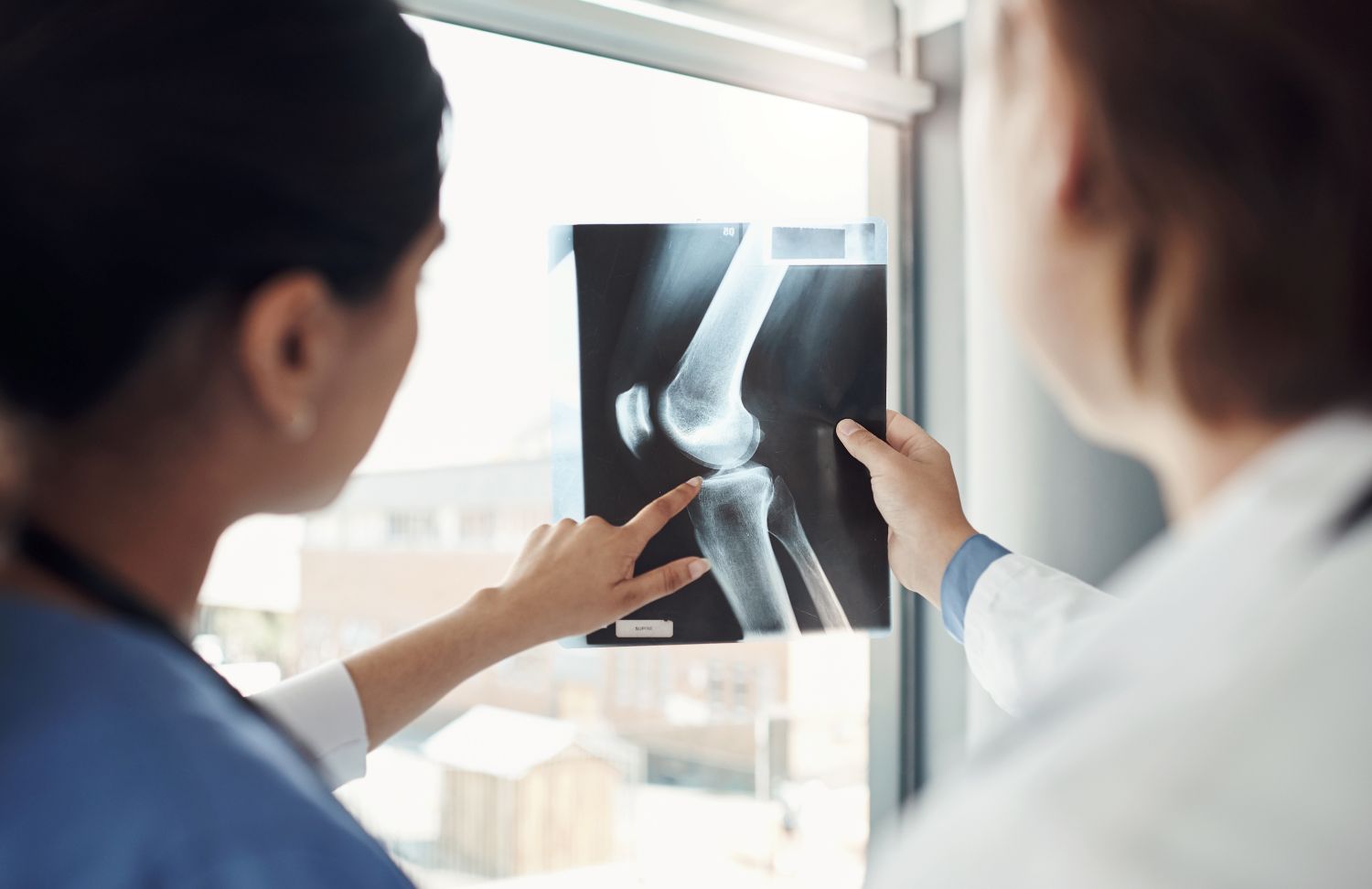 Bone fracture