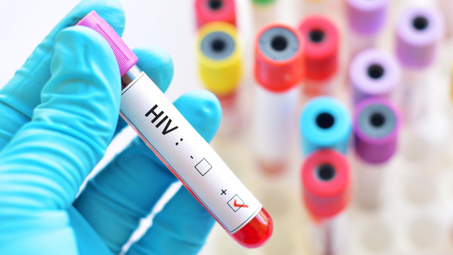 HIV infection